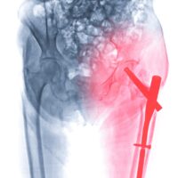 x-ray left hip replacement ,hip painful skeleton x-ray isolated