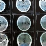 MRI of the brain after trauma